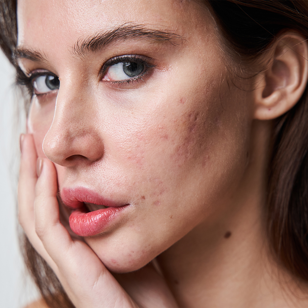 Photo of a woman with acne and acne scars