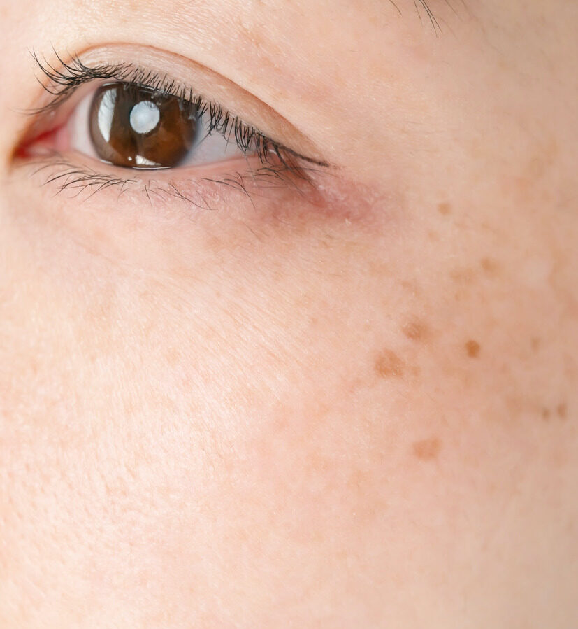 Photo of age spots on a woman's face