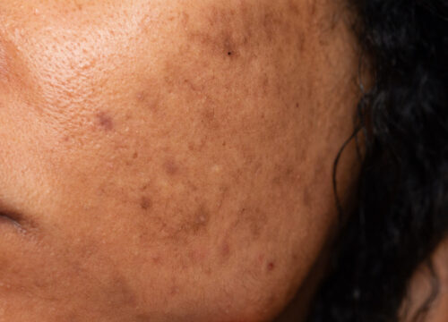 Photo of age spots and other skin concerns on a woman's face