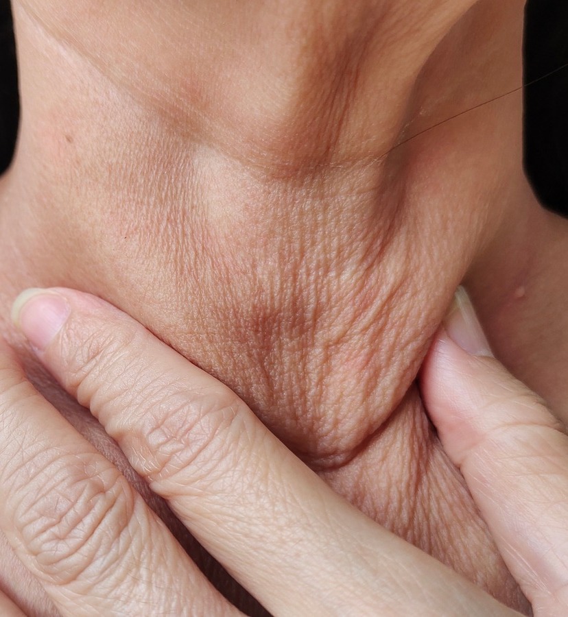 Photo of loose skin on a woman's neck