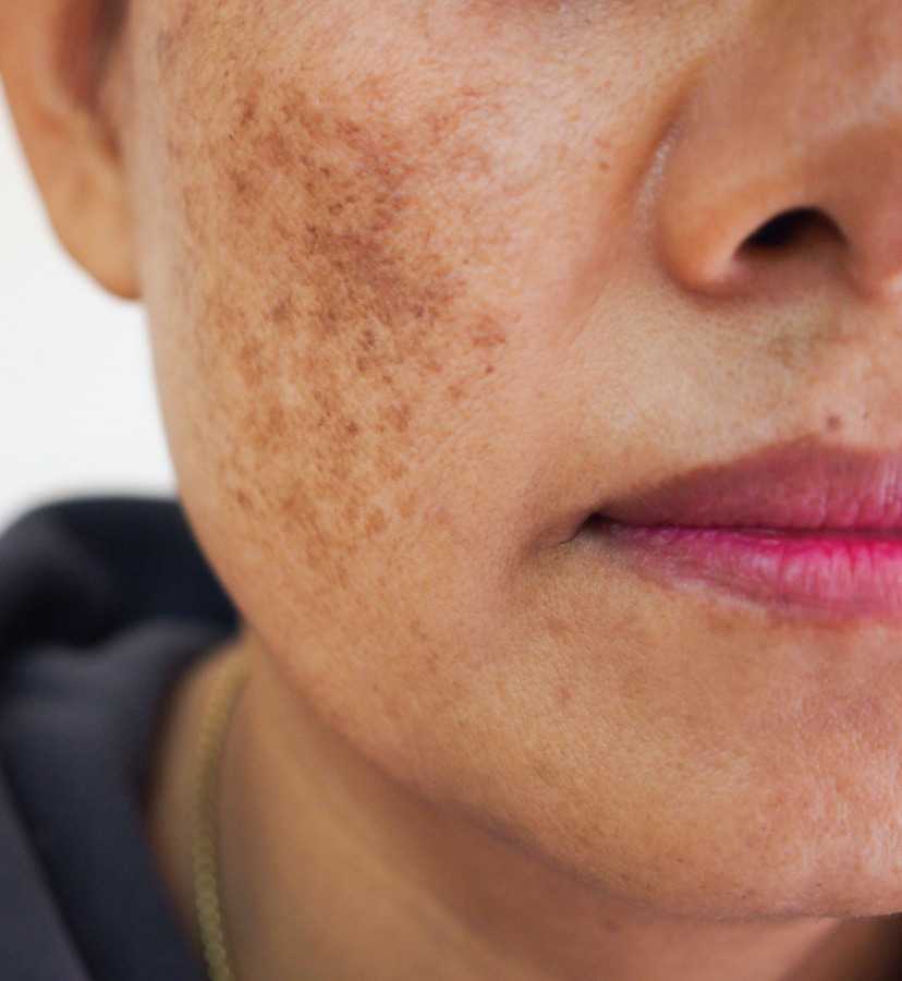 Photo of a woman with sun damage on her cheek