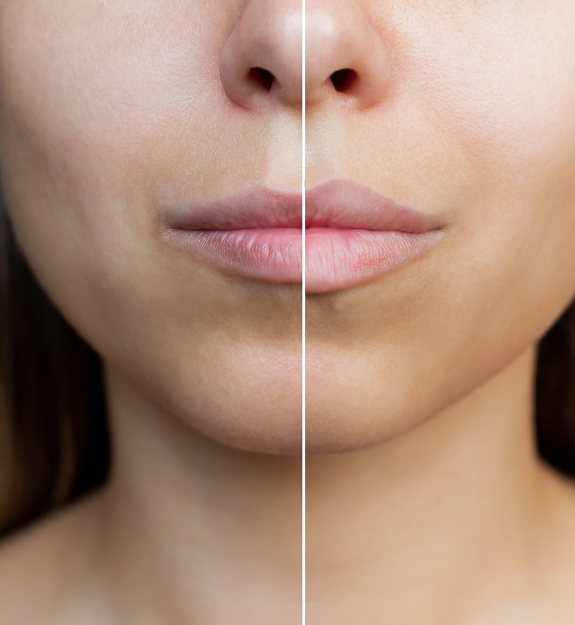 Side by side images of a woman with thin lips and fuller, thicker lips