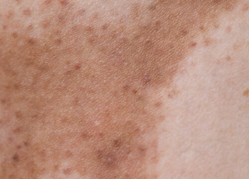 Close-up photo of hyperpigmentation on a person's skin