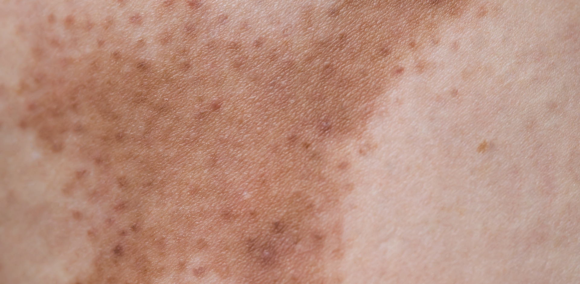 Hyperpigmentation