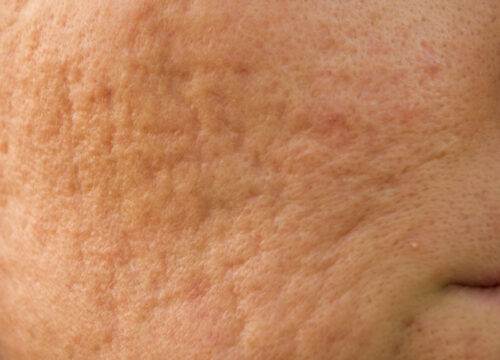 Photo of acne scars on a woman's face