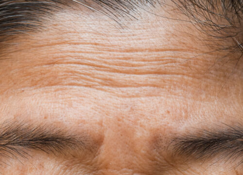 Photo of forehead wrinkles on a woman's face