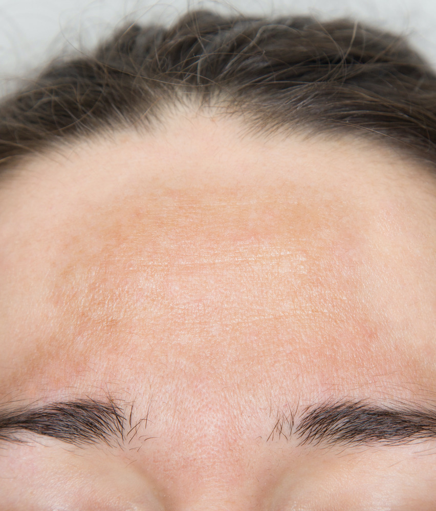 Photo of hyperpigmentation on a woman's forehead