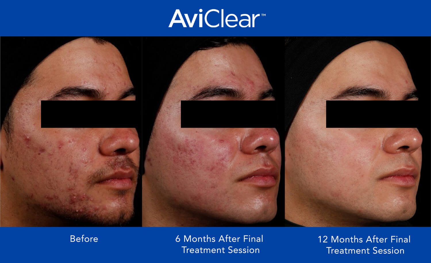 AviClear® before and after results